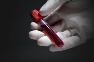 Blood Donations Have Led to Iron Deficiency Anemia